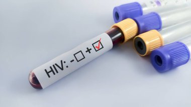 HIV testi pozitif etiketli kan toplama tüpü.