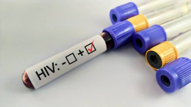HIV testi pozitif etiketli kan toplama tüpü.
