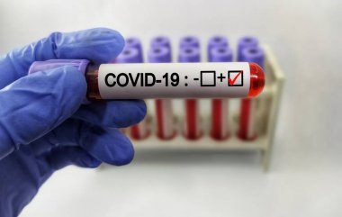 Covid-19 testi için kan örneği içeren test tüpü, Wuhan, Çin 'de bulunan yeni Coronavirus 2019.