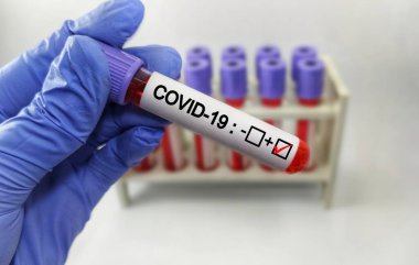 Covid-19 testi için kan örneği içeren test tüpü, Wuhan, Çin 'de bulunan yeni Coronavirus 2019.