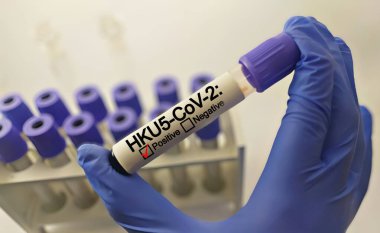 HKU5-CoV-2 için pozitif test sonucu, COVID-19 hastalığına neden olan koronavirüs. Tıbbi konsept.