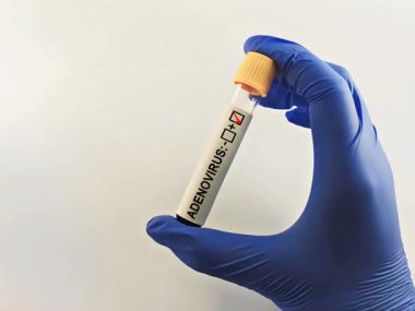 Adenovirüs testi Adenovirüs enfeksiyonu teşhisi.