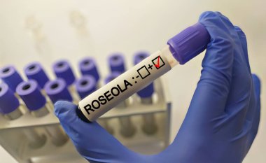 Roseola için kan örnekleri tutan bilim adamı (Exanthem altbitum).