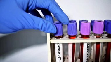 Hepatit için pozitif test sonucu. El doktorunda bir hastalık. Hepatit. Kandaki anormallikleri bulmak için yapılan bir test.