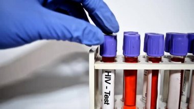 Mavi eldiven giyen doktor bir klinikte üzerinde HIV yazan bir kan testi tüpü tutuyor.,