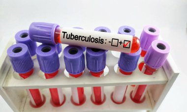 Tüberküloz testi için kan örneğiyle test tüpü, micobakteryum tüberküloz enfeksiyonu için teşhis