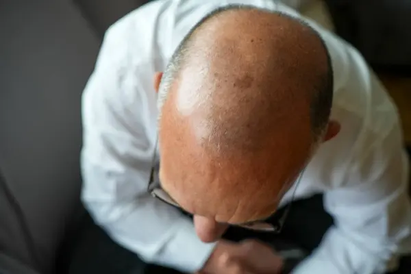 Kısa saçlı bir adamın kel kafasının üst görüntüsü.