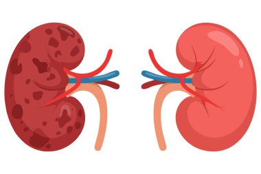 Sağlıklı böbrek ve hastalıklı böbrek taşıyıcı illüstrasyonları, renal sağlık kontrolünün sağlık, eğitim ve farkındalık konuları için mükemmel olduğunu vurgulayan polisistik özelliklere sahiptir.