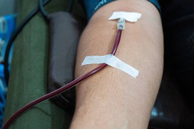 Kan bağışı faaliyetlerinde kateter yoluyla ellerden kan toplama işlemi kan bağışı faaliyetlerinde kateter yoluyla ellerden kan toplama süreci.