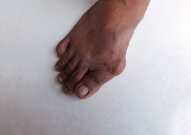 Asyalı kıdemli bir adamın ayağında nasır, başparmağın diğer ayak parmağına doğru eğildiği bir durumdur.