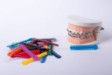 Renkli ortodontik bağlar, tedavi sırasında düzgün diş hizalanması ve istikrarın sağlanması için, parantezlere kemer telleri yerleştirmek üzere tasarlandı..