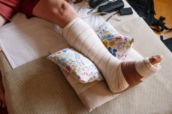 Fractured foot with a bandage made by a doctor.