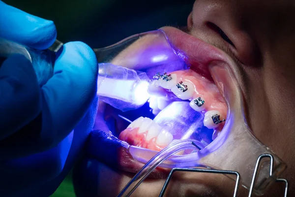 Tiener Bij Tandheelkundige Kliniek Zet Beugel Tanden Corrigeren — Stockfoto