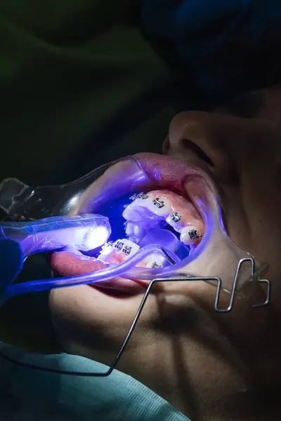 Teenager Der Zahnklinik Setzt Klammer Zur Zahnkorrektur — Stockfoto