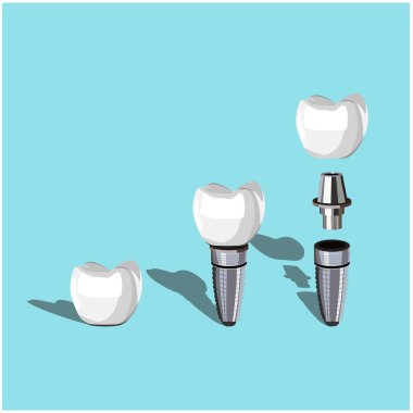 Diş implantlarının gösterişli bir temsili. Diş implantı, protez diş, diş damgalama, eğitim malzemeleri ve ağız cerrahisi tasarımları için mükemmel..