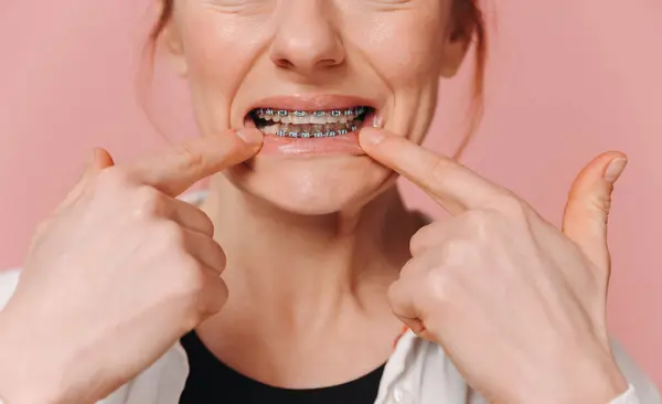 Close-up female pointing fingers at metal braces on pink background, orthodontics concept