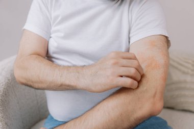 Evdeki oturma odasında oturan yaşlı şişman adamın kollarını kaşırken yakın çekim. Alerji belirtileri. Boşluğu kopyala