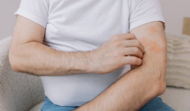 Evdeki oturma odasında oturan yaşlı şişman adamın kollarını kaşırken yakın çekim. Alerji belirtileri. Boşluğu kopyala