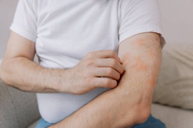 Evdeki oturma odasında oturan yaşlı şişman adamın kollarını kaşırken yakın çekim. Alerji belirtileri. Boşluğu kopyala