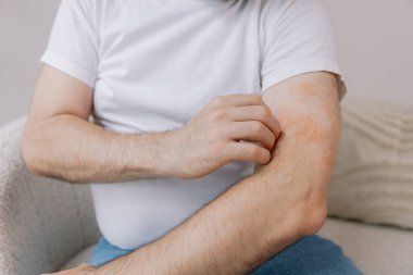 Evdeki oturma odasında oturan yaşlı şişman adamın kollarını kaşırken yakın çekim. Alerji belirtileri. Boşluğu kopyala