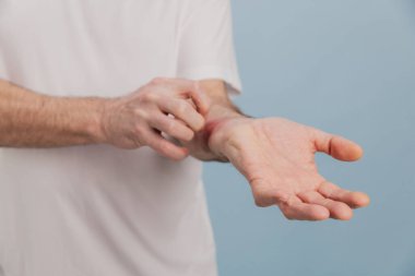 Kaşınan bileğini kaşıyan, deri iltihabı, egzama ya da mavi arka planda alerjisi olan son sınıf öğrencisinin yakın çekimi.