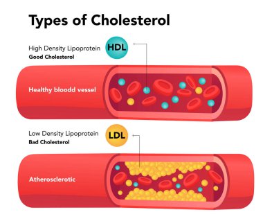 HDL ve LDL hisse senedi örnekleriyle kolesterol karşılaştırması. Kolesterol türleri. Hastalıkları açıklamak için normal ve daralmış arter. hisse illüstrasyonu