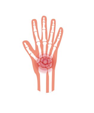 Röntgende ağrı ve iltihap var. İnsan eklemlerinde ve kemiklerinde romatoid eklem iltihabı belirtileri. İskelet tarama konsepti. Parmak hastalığı düz vektör çizimi. Banner, klinik ve hastane posteri