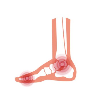 Ayak bileğindeki eklem iltihabı. Romatoid eklem iltihabı. Bacağım ağrıyor. İnsan ayağı anatomisi düz vektör çizimi. İskelet X ışını tarama konsepti. Acı verici yaralanma ve aşınma. Klinik için tıbbi poster.