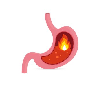 Mide illüstrasyonunda mide yanması.