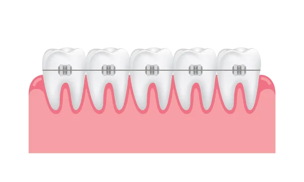 Zubní Rovnátka Ilustrace Zubní Péče Koncepce Zubů — Stockový vektor