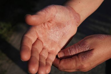 Egzama kaynaklı deri kızarıklığı. İnsan derisinde egzama - yakın dermatit belirtileri. Deri hastalıkları.