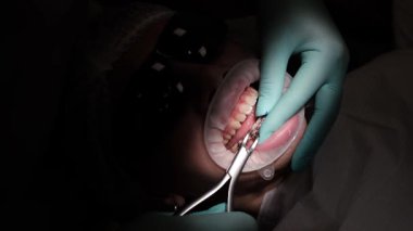 Genç bir kız ortodontistlerin sandalyesinde oturuyor. Yakın plan: ortodontist diş tellerini çıkarırken ağzı sonuna kadar açık. Kendine güvenen sağlıklı bir gülümsemeye doğru yolculuk