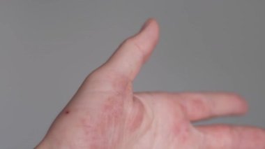 Egzamadan etkilenen kadın ellerinin detaylı görüntüsü. Kabuk soyma, kırmızı ve kaşındıran cilt. Cilt bakımı, sağlık ve alerji için birebirdir..