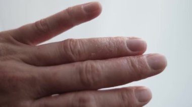 Elin ayrıntılı görünümü kuru pullu yamalar, egzama kuruluğu vurgulandı, tıbbi kullanım için egzama çalışma klipsi 