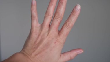 Gün ışığında kronik egzama, pullama ve kızarıklık derisi ile yavaş dönen el, tıbbi illüstrasyon için kullanışlı egzama klipsi