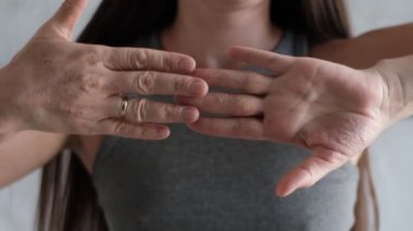 İki elinde de egzama olan bir kadın, pürüzsüz kaşıntılı cilt, ekzama kabarcıkları ve avuçlarda ve parmaklarda görünen kızarıklık, kronik egzama sahnesini gösteren eğitici dermatoloji görüntüleri. 