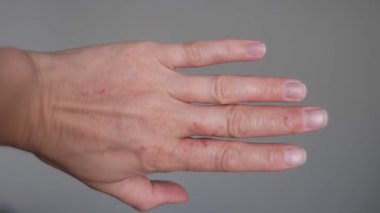 Dermatoloji projeleri için görünen kızarıklık, soyulma ve egzama kaynaklı egzama tarafından etkilenen bir elin görünümü