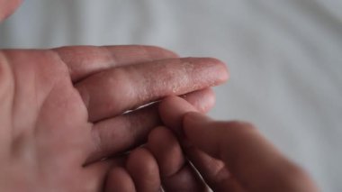 Egzamadan etkilenen kadın parmak, kabuklu kabukları nazikçe seçen kadın, kaşındıran kuraklık ve egzama rahatsızlığını vurgulayan, egzama hakkında faydalı tıbbi dermatoloji eğitimi içeriği eğitim içeriği 