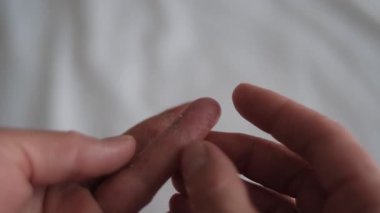 Makro sahne kadını el derisi, döner parmaklar, yumuşak kabukları soymak, egzama kuruluğu görünür, egzama tahrişi vurgulanmış, dermatoloji çalışması için kronik egzama örneği 