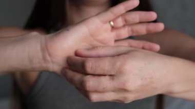 Deri iltihabı yüzünden kaşınan bir kadın. Hastalık gözle görülür şekilde tahriş olmuş eller. Farkındalık kampanyaları veya sağlık reklamları için mükemmel..