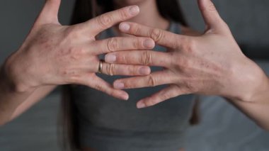 Orta ölçekli yakın çerçeve, elleri birbirine dolanmış ve parmaklarını uzatan bir kadın sunar. Egzama lezyonları, ışık pullu yamaları gösterir. Olay yeri, kronik egzama patlaması sırasında egzama detaylarını vurgular.