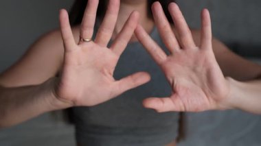 Egzama hastası bir kadının elleri. Kırmızılık, soyulma ve rahatsızlık açıkça görülüyor. Dermatolojiyle ilgili temalar için kullanışlı.