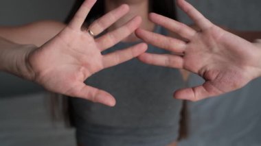 Egzamadan ağır çekimde etkilenen kadın ellerinin detaylı görüntüsü. Kabuk soyma, kırmızı ve kaşındıran deri. Cilt bakımı, sağlık ve alerji için birebirdir..