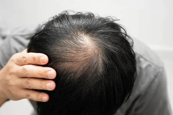 Kel kafalı adam, saç dökülmesi tedavisi sorunu.