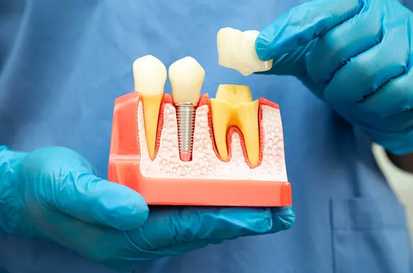 Diş implantı, çeneye yapay diş kökleri, diş tedavisinin kök kanalı, diş eti hastalığı, diş hekimliği üzerine çalışan dişçi modeli.