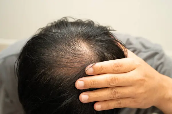 Kel kafalı adam, saç dökülmesi tedavisi sorunu.