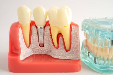 Diş implantı, çeneye yapay diş kökleri, diş tedavisinin kök kanalı, diş eti hastalığı, diş hekimliği üzerine çalışan dişçi modeli.