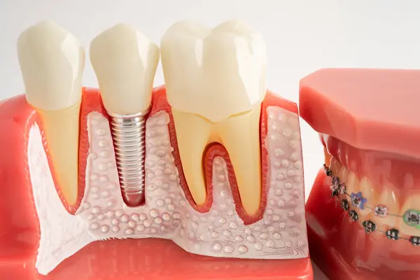 Diş implantı, çeneye yapay diş kökleri, diş tedavisinin kök kanalı, diş eti hastalığı, diş hekimliği üzerine çalışan dişçi modeli.