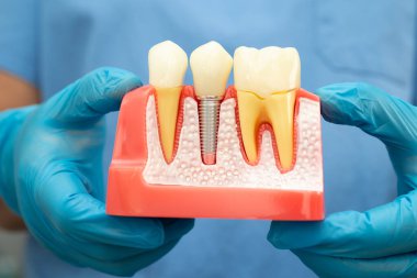 Diş implantı, çeneye yapay diş kökleri, diş tedavisinin kök kanalı, diş eti hastalığı, diş hekimliği üzerine çalışan dişçi modeli.