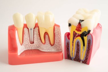 Diş implantı, çeneye yapay diş kökleri, diş tedavisinin kök kanalı, diş eti hastalığı, diş hekimliği üzerine çalışan dişçi modeli.